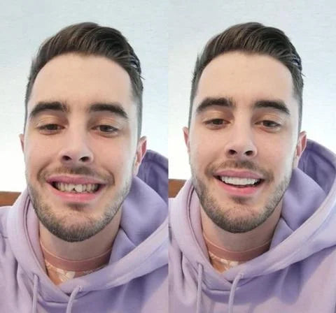 Carillas Dentales Snap On Smile (Incluye las 2)